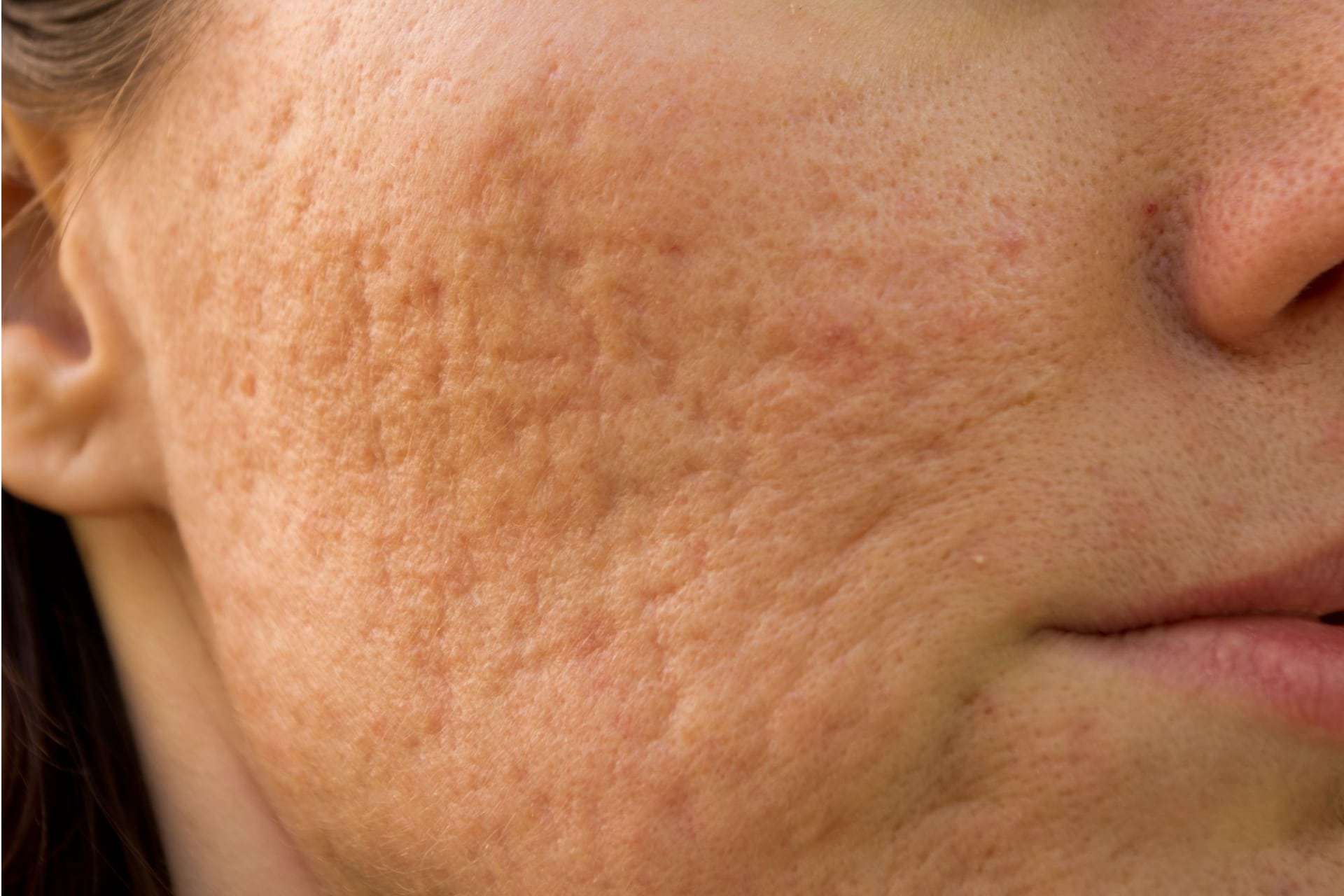 acne scar treatment in delhi
